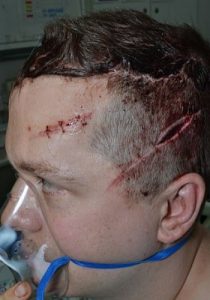 PC Stuart Outten in hospital after the attack